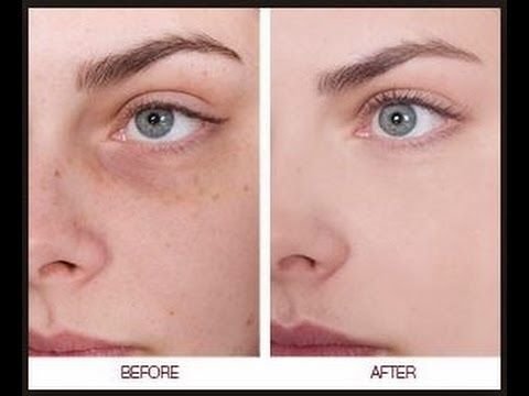 أسباب الكلف في اليمن والسعودية